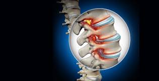 What is Spinal Stenosis?