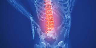 Degenerative Disc Disease: A Comprehensive Guide
